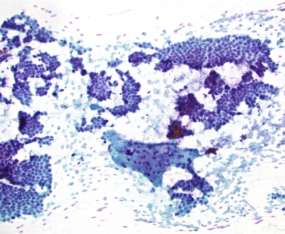 Papillary Carcinoma, low power, with giant cell
Papillary Carcinoma in sheets, low power, with giant cell
Keywords: giant Cell Papillary Carcinoma