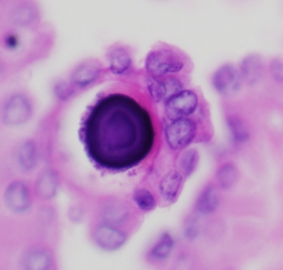 Psammoma Body in papillary carcinoma
Actually an H&E Cell Block with typical psammoma body in papillary carcinoma
Keywords: Psammoma body Papillary Carcinoma