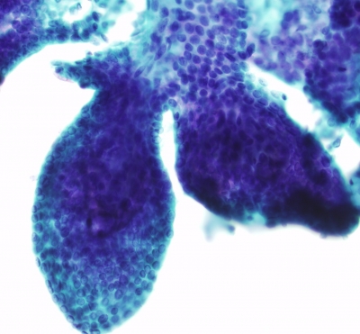 Papillary Carcinoma with Papillary End Caps
Cellular papillary group with overlapping nuclei and rounded papillary structures known as end caps.
Keywords: Papillary Carcinoma End_Caps