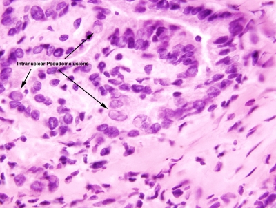 Papillary Carcinoma of Thyroid-Frozen Section
Intranuclear Pseudoinclusions.
Keywords: Papillary Carcinoma, Frozen Section, Pseudoinclusions