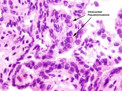 Papillary Carcinoma of Thyroid-Frozen Section
Keywords: Papillary Carcinoma, Frozen Section