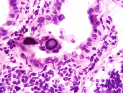 Papillary Carcinoma of Thyroid-Frozen Section
Psammoma Body in Papillary Carcinoma.
Keywords: Papillary Carcinoma, Frozen Section, Psammoma Body