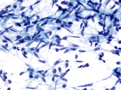 Spindle cell morphology may be prominent. 
Keywords: Medullary Carcinoma, Spindle Cell