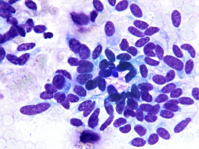 Relatively monomorphic fusiform cells and amyloid.
Keywords: Medullary Carcinoma, Spindle Cell