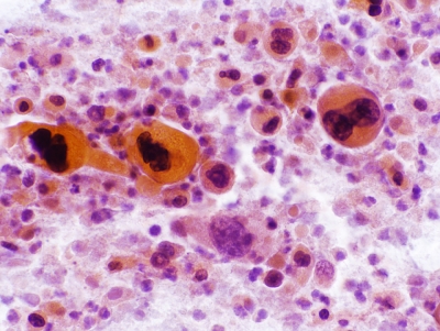 Squamous Cell Carcinoma of the Thyroid.
Keratinizing malignant cells with necrosis.
Keywords: Squamous Cell Carcinoma, Keratinizing