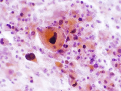 Squamous Cell Carcinoma of the Thyroid.
Keratinizing malignant cells with necrosis.
Keywords: Squamous Cell Carcinoma, Keratinizing