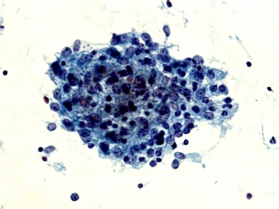 Granuloma.
Keywords: Granulomatous Thyroiditis