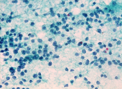 Numerous monomorphic lymphocytes.
Keywords: Suspicious, Lymphoma, Malignancy