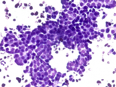 Monolayered sheet of follicular cells with nuclear elongation, chromatin clearing and nuclear grooves
Keywords: Suspicious for Papillary Carcinoma, Susp for PTC
