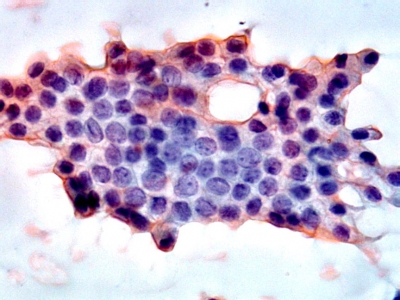 Monolayered sheet of follicular cells with oval nuclei, nuclear grooves and focal chromatin clearing.
Keywords: Suspicious for Papillary Carcinoma, Susp for PTC