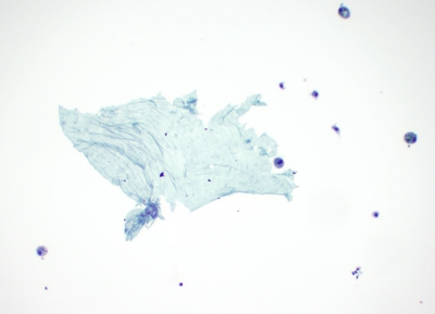 "Tissue paper" colloid (ThinPrep®)
Colloid in liquid based preparation.
Keywords: ThinPrep®, Colloid, Acellular