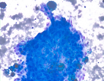 Crowded sheet of atypical follicular cells associated with cystic contents.
Keywords: Suspicious for Cystic Papillary Carcinoma Ultrasound