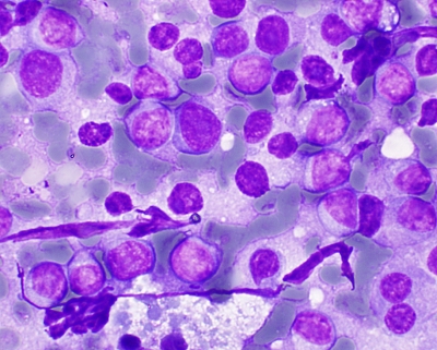 Plasmacytoid B-Cell Lymphoma in Thyroid FNA
Plasmacytopid B-Cell Lymphoma in Thyroid FNA
Keywords: B-Cell Lymphoma Plasmacytoid