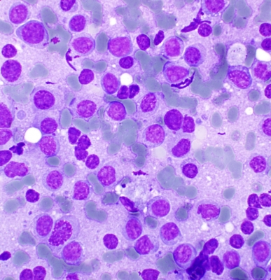 Plasmacytoid B-Cell Lymphoma in Thyroid FNA
Dyscohesive malignant cells from a thyroid FNA. cd20 positive
Keywords: Plasmacytoid B-Cell Lymphoma 