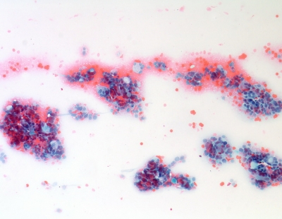Non-diagnostic due to obscuring blood and air drying artifact.
Keywords: Non-Diagnostic, Air Drying