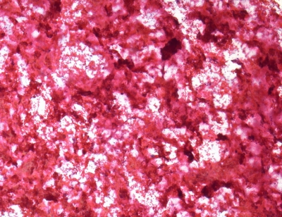 Non-diagnostic; blood only.
Keywords: Non-Diagnostic, No thyroid elements
