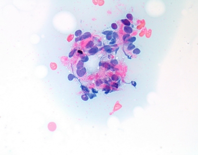 Non-diagnostic due to extensive air drying artifact
Keywords: Non-Diagnostic, Air Drying