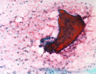 Non-diagnostic. No follicular cells; skeletal muscle fragment only.
Keywords: Non-Diagnostic, No thyroid elements