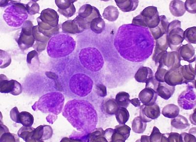 Metastasis, Suspicious for Prostate Carcinoma
Large malignant cells in patient with history of high grade prostate carcinoma
Keywords: Metastatic, Prostate Carcinoma, Giemsa