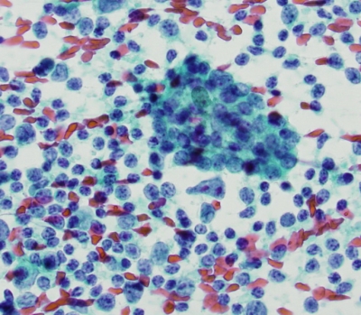 Polymorphous population of lymphocytes.
Keywords: Chronic Lymphocytic Thyroiditis, Hashimoto, Lymphocytes