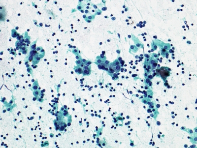 Lymphocytes and Hurthle cells (oncocytic metaplasia)
Keywords: Chronic Lymphocytic Thyroiditis (Hashimoto) Hurthle Cells and Lymphocytes