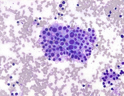 Graves Disease with Flame cells
Graves Disease with Flame Cells
Keywords: Graves Disease, Flame Cells