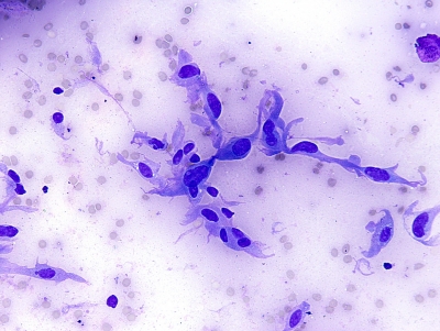 Atypia of Undetermined Significance/Follicular Lesion of Undetermined Significance
Rare atypical cells in this preparation lead to a 
determination of AUS
Keywords: Atypia of Undetermined Significance