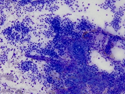 Very cellular specimen with numerous microfollicles and minimal colloid.
Keywords: Follicular Neoplasm
