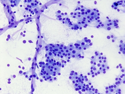 Capillaries.
Keywords: Follicular Neoplasm