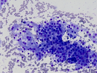 Benign follicular cells.
Keywords: Adenomatoid, Cellular Goiter, Cellular nodule, adenomatous hyperplasia in colloid goiter