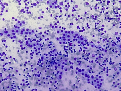 Polymorphous lymphocytes and Hurthle cells.
Keywords: Hashimoto, Autoimmune, Chronic Lymphocytic Thyroiditis