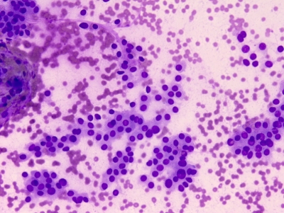 Very cellular specimen with trabecular arrangements (ribbons) of follicular cells and minimal colloid.
Keywords: Follicular Neoplasm