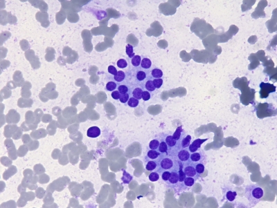 Microfollicles.
Keywords: Follicular Neoplasm