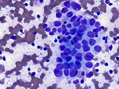 Mild nuclear crowding can be a feature of lymphocytic thyroiditis.
Keywords: Hashimoto, Autoimmune, Chronic Lymphocytic Thyroiditis