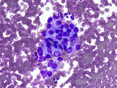 Intranuclear pseudoinclusions.
Keywords: Papillary Carcinoma, FNA