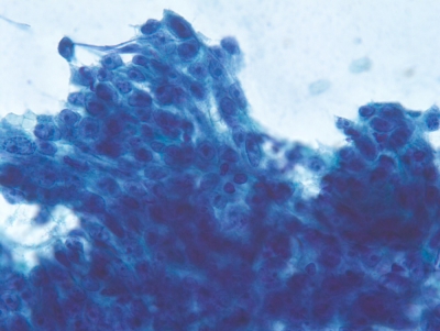 Large atypical cells with macronucleoli. (Histologic follow-up revealed a carcinoma with thymus-like differentiation [CASTLE]).
Keywords: Suspicious for Poorly Differentiated Carcinoma (insular) result CASTLE