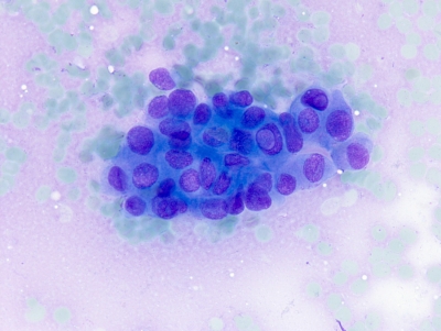 Papillary thyroid carcinoma with intranuclear pseudoinclusions.
Keywords: Papillary Carcinoma with Intranuclear Pseudoinclusion