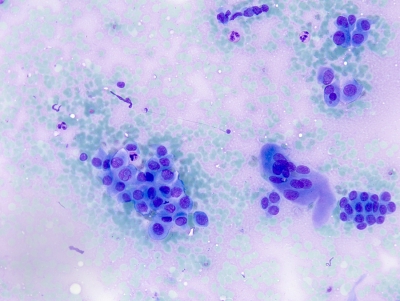 Papillary thyroid carcinoma with intranuclear pseudoinclusions.
Keywords: Papillary Carcinoma with Intranuclear Pseudoinclusion