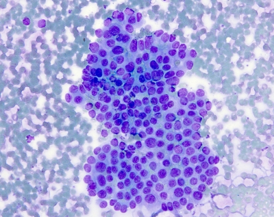 Papillary thyroid carcinoma. Note that there is only slight cellular overlap in this case.
Keywords: Papillary Thyroid Carcinoma Overlap