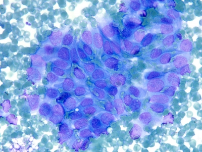 Papillary thyroid carcinoma. Note the anisonucleosis.
Keywords: Papillary Thyroid Carcinoma anisonucleosis