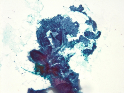 Branching papillae and monolayered sheets.
Keywords: Papillary Carcinoma with Powdery Chromatin