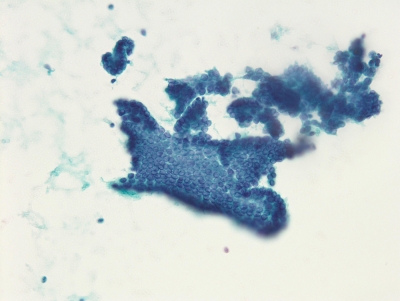 Nuclear crowding and powdery chromatin.
Keywords: Papillary Carcinoma with Powdery Chromatin