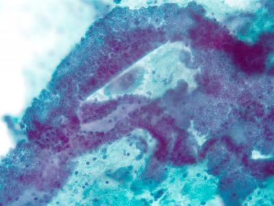 Complex, three-dimensional architecture with crowded nuclei.
Keywords: Papillary Carcinoma