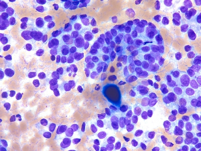 Papillary thyroid carcinoma. 
Keywords: Papillary Thyroid Carcinoma,  Endcap of papillary group