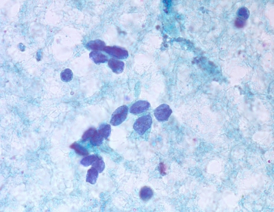 Poorly Differentiated Carcinoma (Insular Carcinoma)

