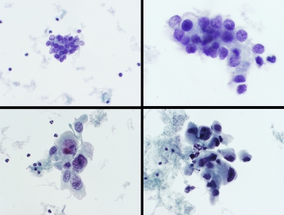 Mixed papillary carcinoma (upper images) and anaplastic carcinoma (lower images) (ThinPrep).
Keywords: Carcinoma with Mixed Features, anaplastic, papillary