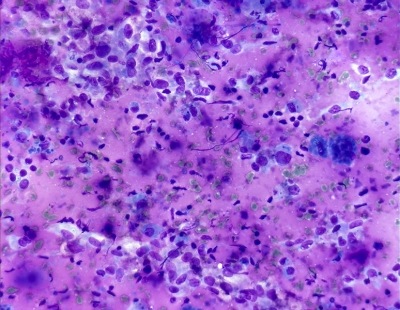 Polymorphous pattern with occasional epithelioid histiocytes.
Keywords: Granulomatous (subacute) thyroiditis