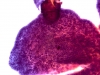 Filename=Cystic_PTC-3.jpg
Filesize=98KiB
Dimensions=864x648
Date added=Apr 23, 2010 Cystic_PTC-3.jpg