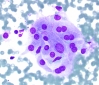 Filename=Hashimotos,_oncocytes,_DQ_hp_SM.jpg
Filesize=1175KiB
Dimensions=1088x934
Date added=May 25, 2015 Hashimotos,_oncocytes,_DQ_hp_SM.jpg