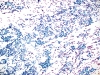 Filename=Hashimotos,_prominant_microfollicular_pattern,_PAP_lp_SM.jpg
Filesize=1146KiB
Dimensions=1050x791
Date added=May 25, 2015 Hashimotos,_prominant_microfollicular_pattern,_PAP_lp_SM.jpg